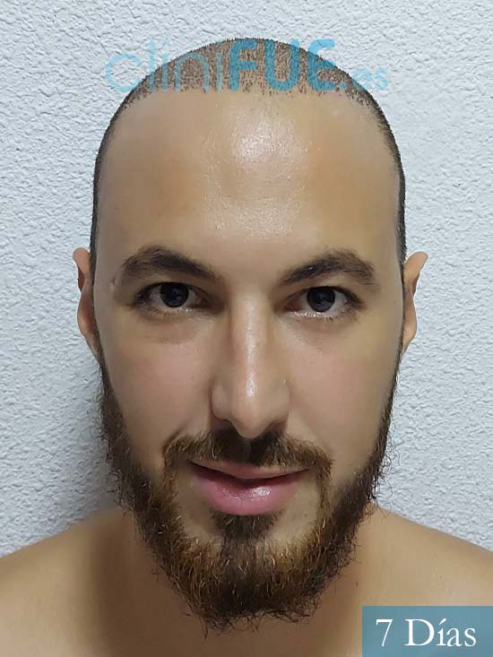 Sebastian 25 Valencia trasplante capilar turquia 7 dias 
