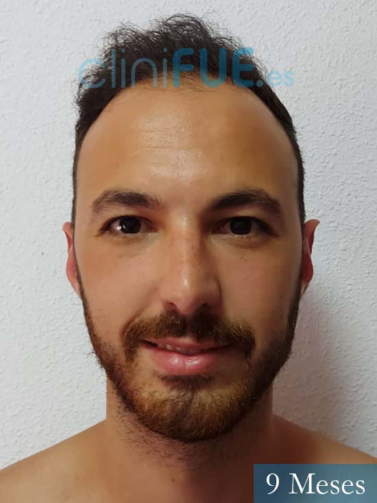 Sebastian 25 Valencia trasplante capilar turquia 9 meses 1