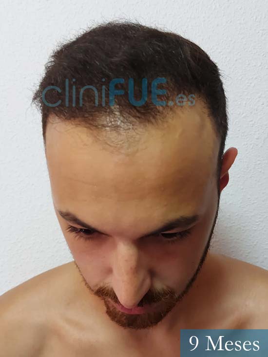 Sebastian 25 Valencia trasplante capilar turquia 9 meses 2