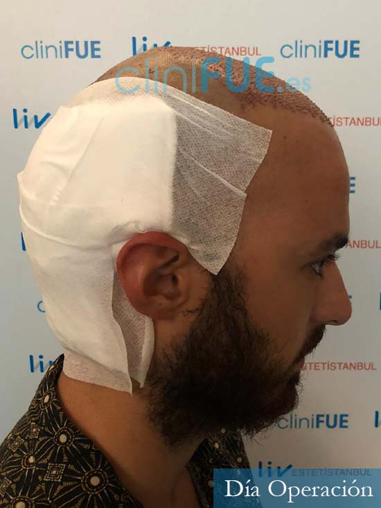 Sebastian 25 Valencia trasplante capilar turquia antes 3