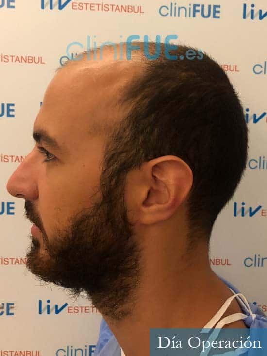 Sebastian 25 Valencia trasplante capilar turquia antes 4
