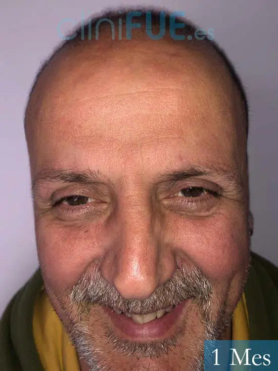 Juan Carlos-48-anos-vizcaya-injerto-capilar-turquia-3 meses 1
