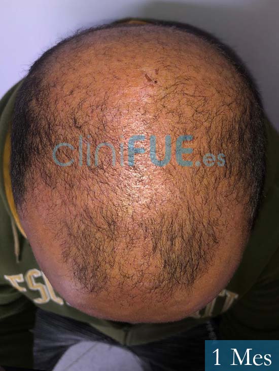 Juan Carlos-48-anos-vizcaya-injerto-capilar-turquia-3 meses 3