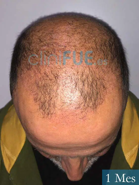 Juan Carlos-48-anos-vizcaya-injerto-capilar-turquia-3 meses 2