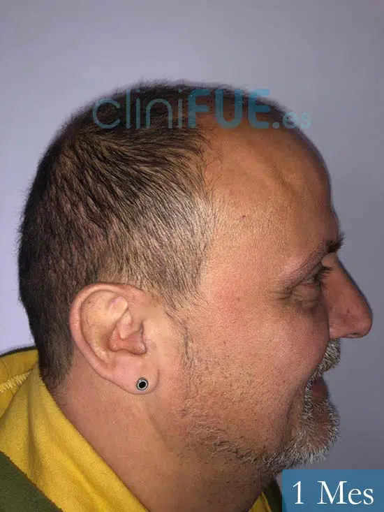 Juan Carlos-48-anos-vizcaya-injerto-capilar-turquia-3 meses 4
