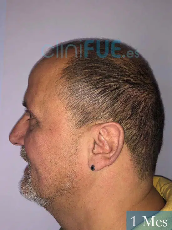 Juan Carlos-48-anos-vizcaya-injerto-capilar-turquia-3 meses 5