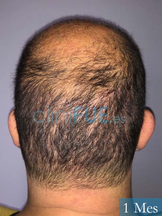 Juan Carlos-48-anos-vizcaya-injerto-capilar-turquia-3 meses 6