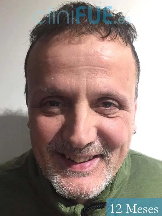 Juan Carlos-48-anos-vizcaya-injerto-capilar-turquia-12 meses-1
