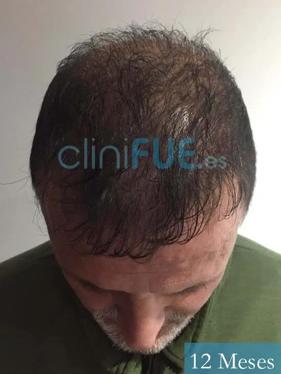 Juan Carlos-48-anos-vizcaya-injerto-capilar-turquia-12 meses-2