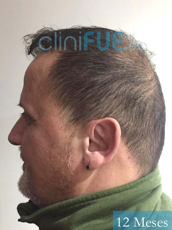 Juan Carlos-48-anos-vizcaya-injerto-capilar-turquia-12 meses-4