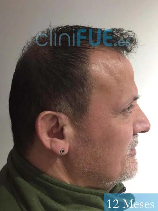 Juan Carlos-48-anos-vizcaya-injerto-capilar-turquia-12 meses-3