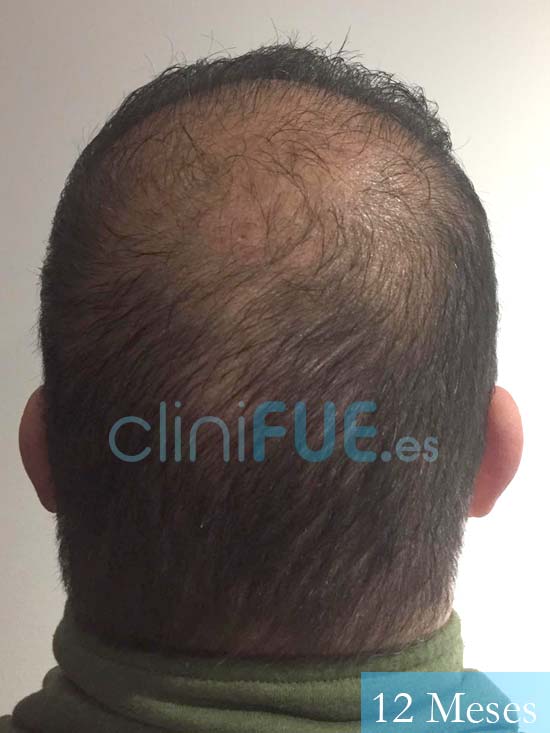 Juan Carlos-48-anos-vizcaya-injerto-capilar-turquia-12 meses-5