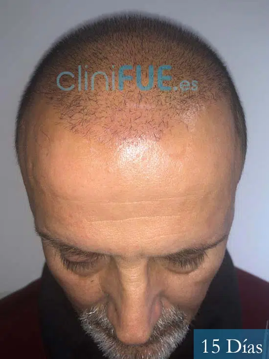 Juan Carlos-48-anos-vizcaya-injerto-capilar-turquia-15 dias-2