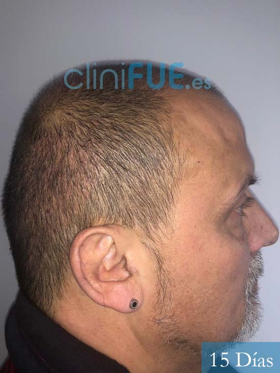 Juan Carlos-48-anos-vizcaya-injerto-capilar-turquia-15 dias-3