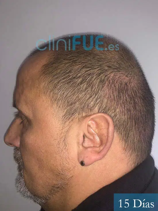 Juan Carlos-48-anos-vizcaya-injerto-capilar-turquia-15 dias-5
