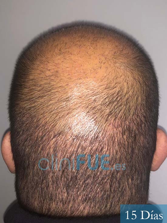 Juan Carlos-48-anos-vizcaya-injerto-capilar-turquia-15 dias-6