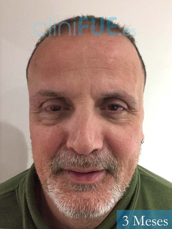 Juan Carlos-48-anos-vizcaya-injerto-capilar-turquia-3 meses-