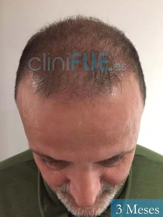 Juan Carlos-48-anos-vizcaya-injerto-capilar-turquia-3 meses-2