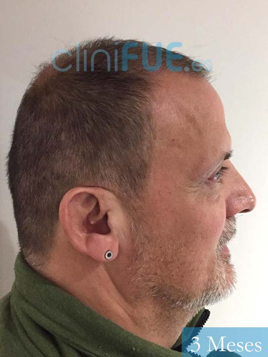Juan Carlos-48-anos-vizcaya-injerto-capilar-turquia-3 meses-4