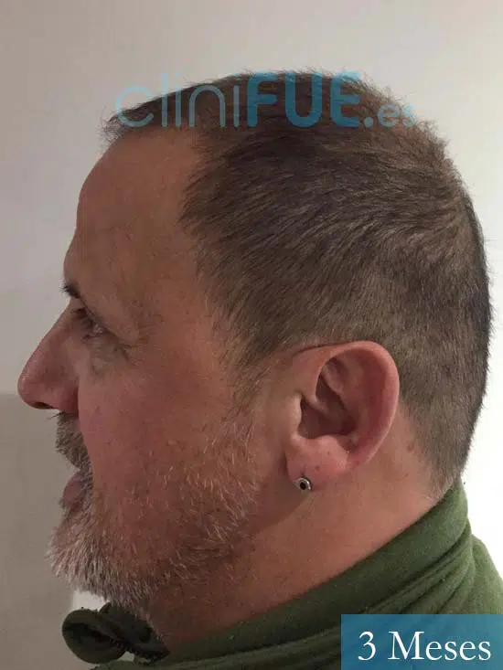 Juan Carlos-48-anos-vizcaya-injerto-capilar-turquia-3 meses-5