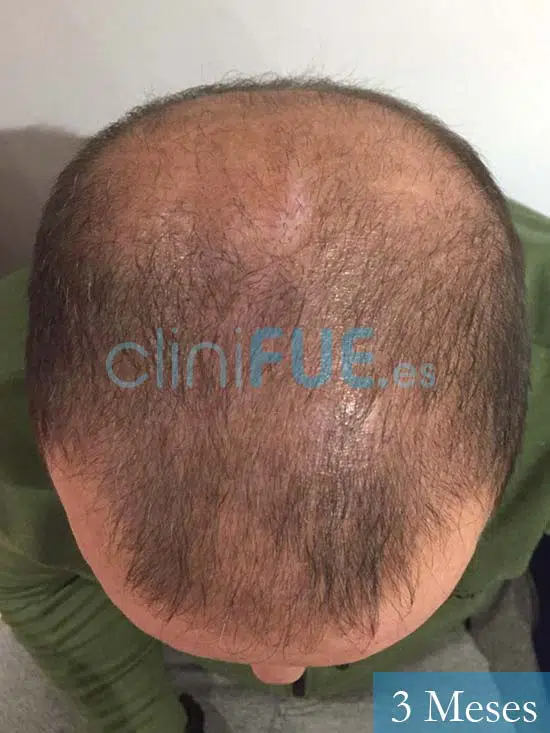 Juan Carlos-48-anos-vizcaya-injerto-capilar-turquia-3 meses-3