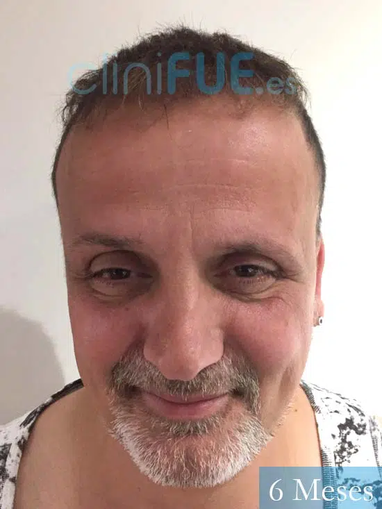 Juan Carlos-48-anos-vizcaya-injerto-capilar-turquia-6 meses-1