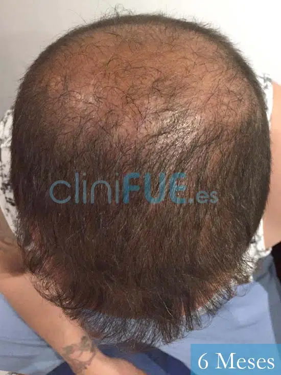 Juan Carlos-48-anos-vizcaya-injerto-capilar-turquia-6 meses-3