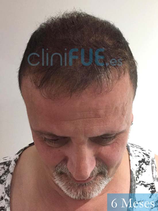 Juan Carlos-48-anos-vizcaya-injerto-capilar-turquia-6 meses-2