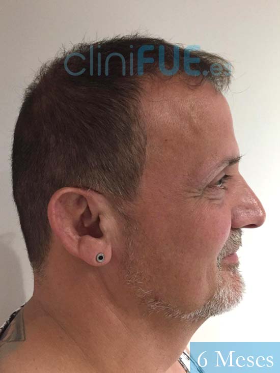 Juan Carlos-48-anos-vizcaya-injerto-capilar-turquia-6 meses-4