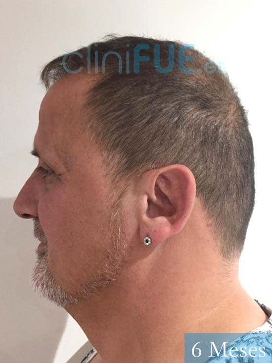 Juan Carlos-48-anos-vizcaya-injerto-capilar-turquia-6 meses-5
