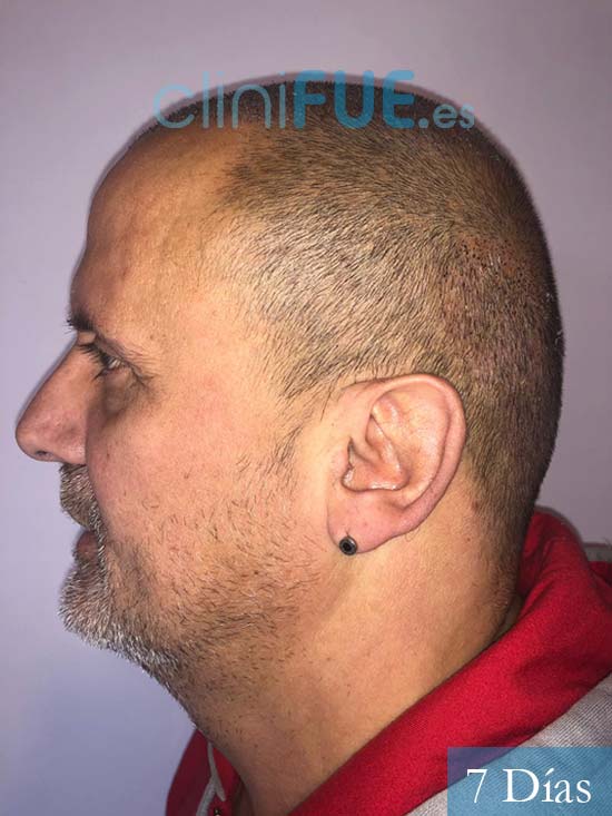 Juan Carlos-48-anos-vizcaya-injerto-capilar-turquia-7 dias-5