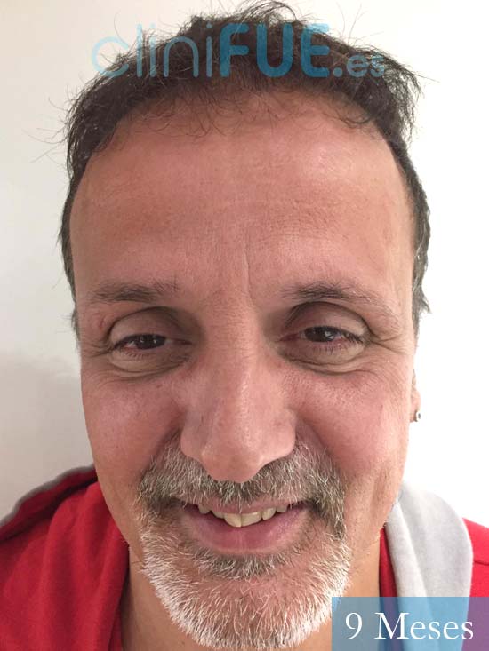 Juan Carlos-48-anos-vizcaya-injerto-capilar-turquia-9 meses-1