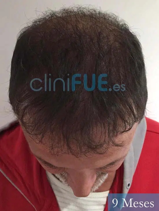 Juan Carlos-48-anos-vizcaya-injerto-capilar-turquia-9 meses-2