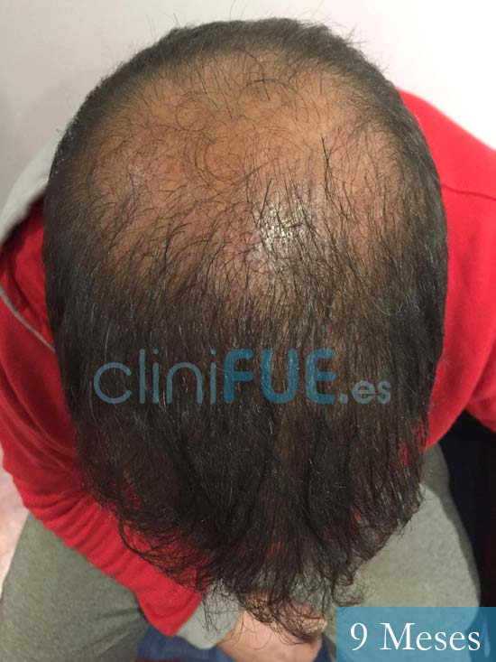 Juan Carlos-48-anos-vizcaya-injerto-capilar-turquia-9 meses-3