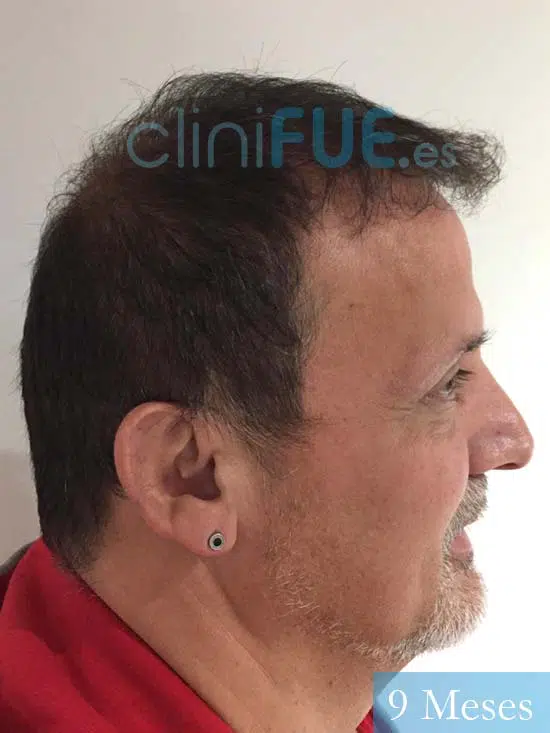 Juan Carlos-48-anos-vizcaya-injerto-capilar-turquia-9 meses-4