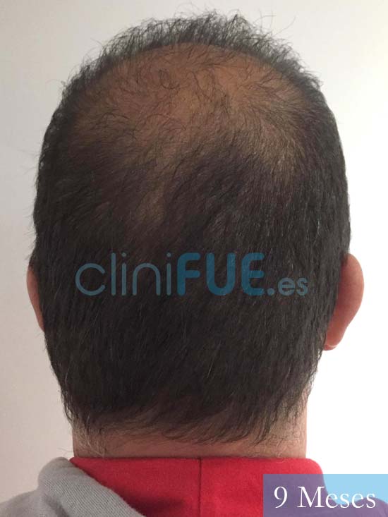 Juan Carlos-48-anos-vizcaya-injerto-capilar-turquia-9 meses-6