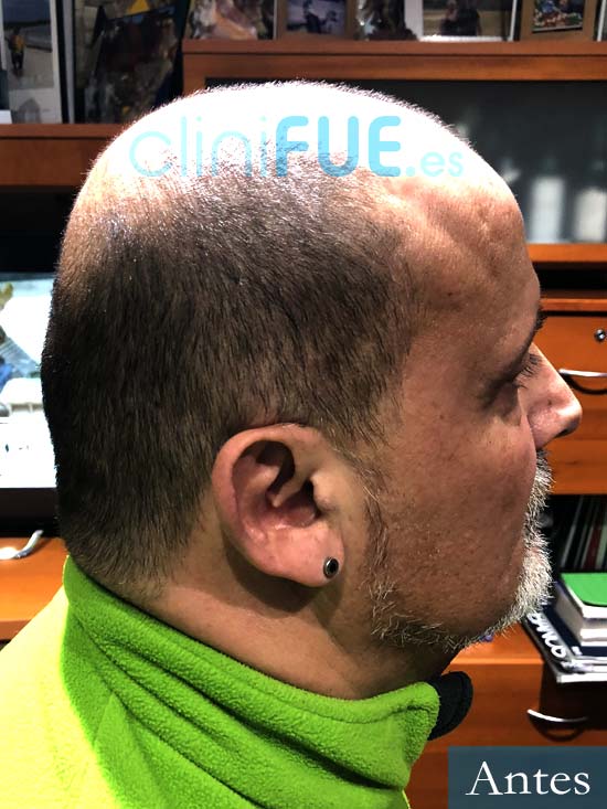 Juan Carlos-48-anos-vizcaya-injerto-capilar-turquia-antes-4