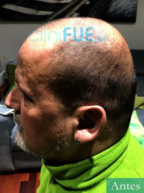 Juan Carlos-48-anos-vizcaya-injerto-capilar-turquia-antes-5