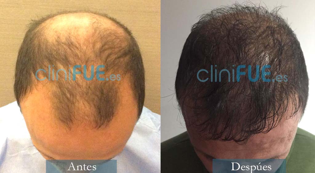 Juan Carlos-48-anos-vizcaya-injerto-capilar-turquia-12 meses-1