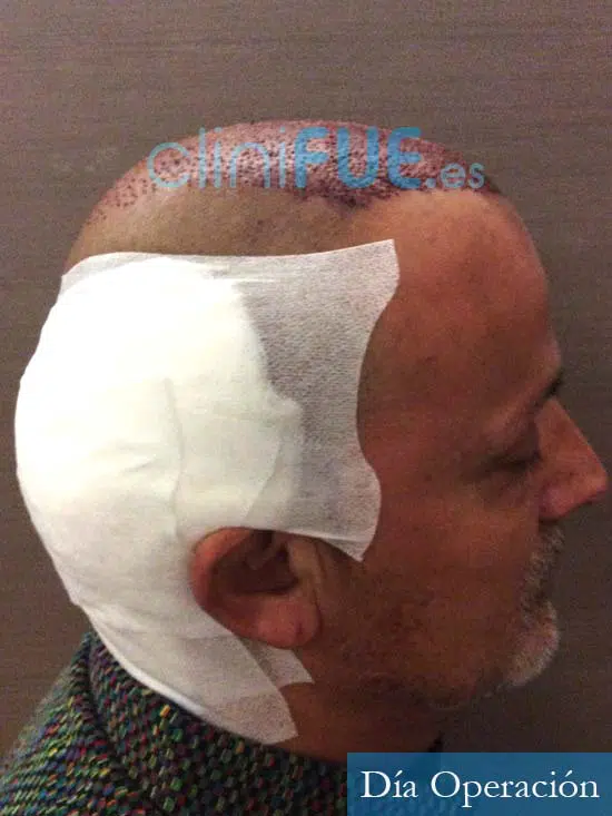 Juan Carlos-48-anos-vizcaya-injerto-capilar-turquia-dia operacion-5