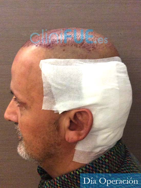 Juan Carlos-48-anos-vizcaya-injerto-capilar-turquia-dia operacion-6