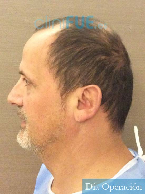 Juan Carlos-48-anos-vizcaya-injerto-capilar-turquia-dia operacion-4