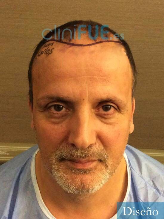 Juan Carlos-48-anos-vizcaya-injerto-capilar-turquia-dia operacion-2