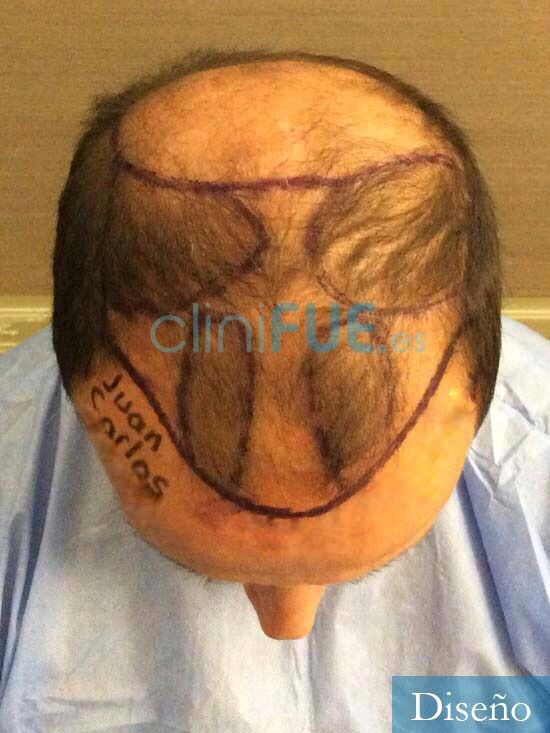 Juan Carlos-48-anos-vizcaya-injerto-capilar-turquia-dia operacion-2