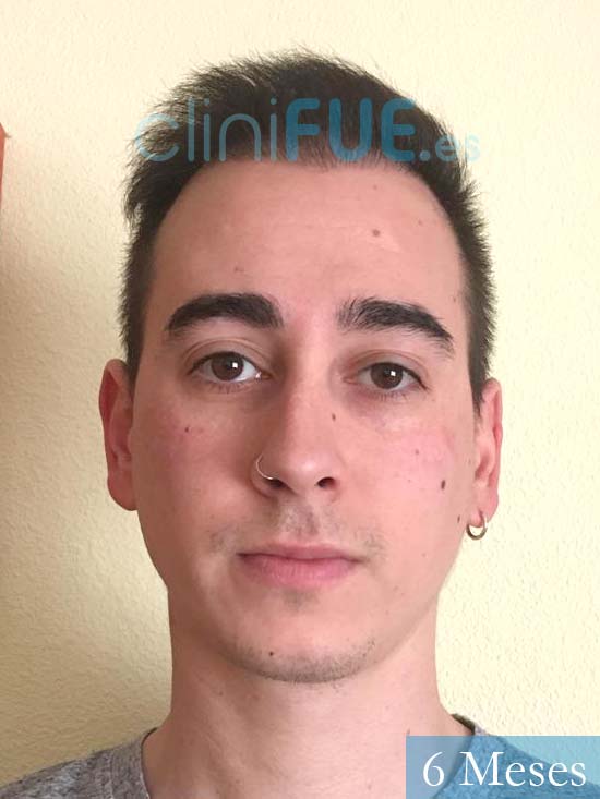 Juan Luis-34-Cordoba-trasplante-turquia-6-meses-1