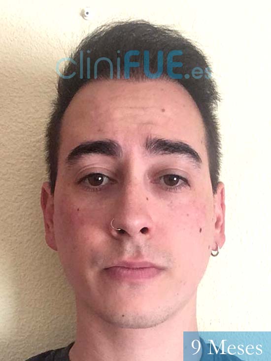 Juan Luis-34-Cordoba-trasplante-turquia-9meses-
