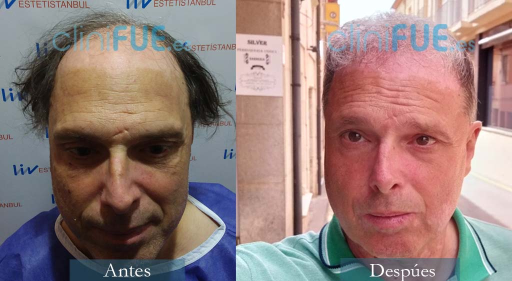 Injerto capilar de Rene 52 Años de Girona con cliniFUE