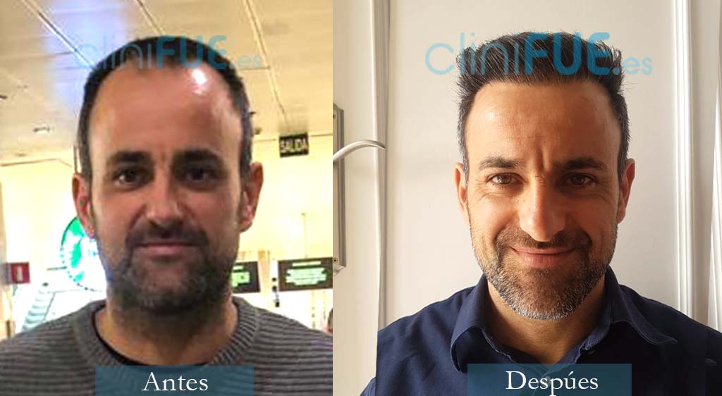 Trasplante capilar de Juan 39  Años de Murcia con cliniFUE