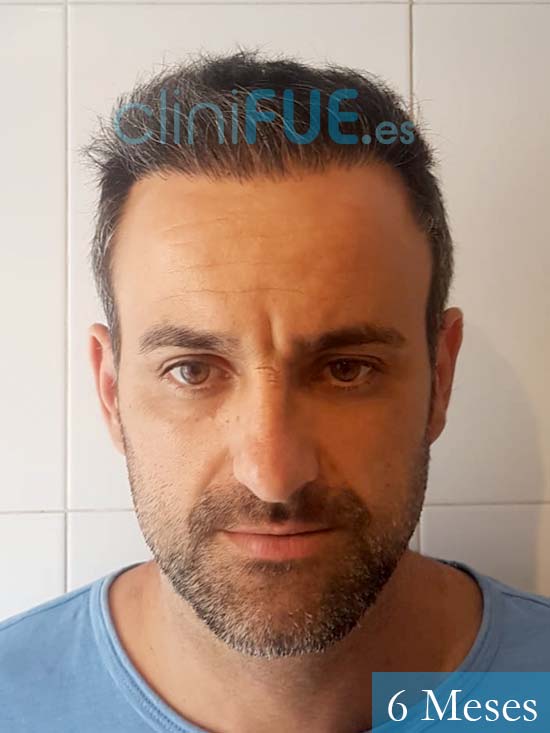 Juan 39 Murcia trasplante pelo 6 meses 