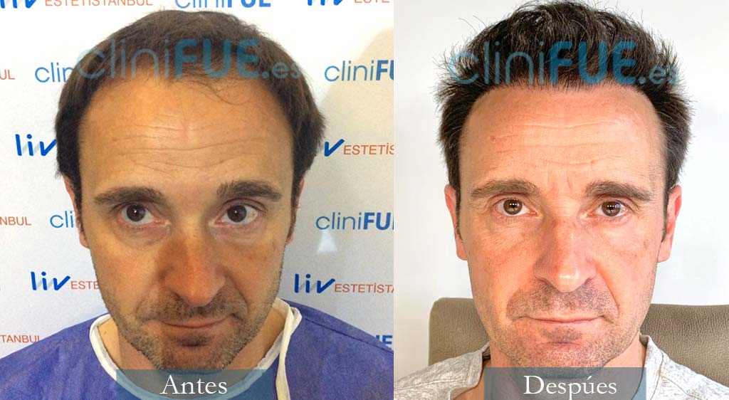 Injerto capilar de Miguel Angel 42 Años de MAdrid con cliniFUE